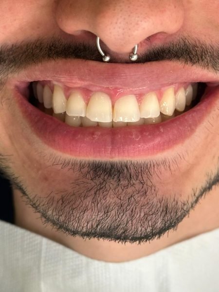 ANTES Um caso de estética com resina composta para melhorar o formato dos dentes. Feito pela Dra. Izabelle (equipe IMPLANTS BH).