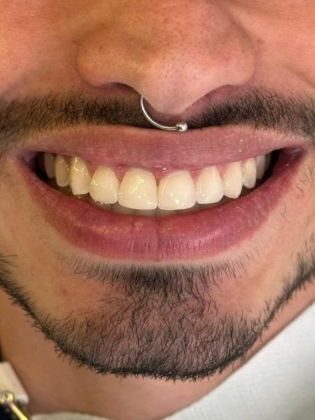 DEPOIS Um caso de estética com resina composta para melhorar o formato dos dentes. Feito pela Dra. Izabelle (equipe IMPLANTS BH).